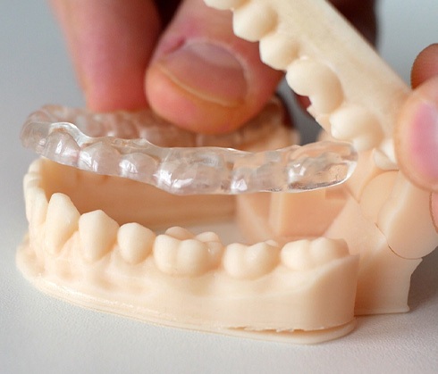 A dentist placing a custom nightguard on a mouth mold