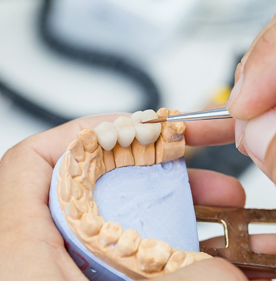 A dental bridge is a series of prosthetic teeth that replace missing teeth