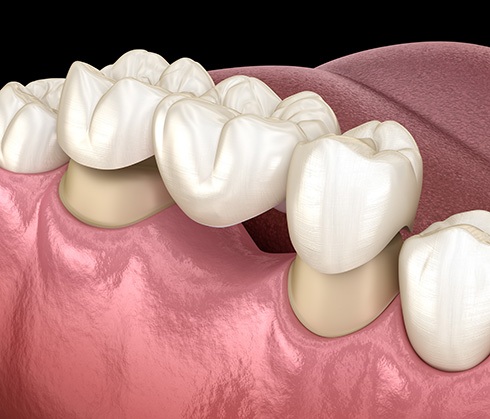 A traditional dental bridge anchors to your healthy teeth