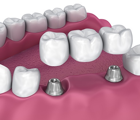 An implant bridge attaches via dental implants