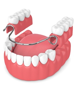 Model of a partial denture