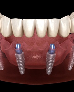 Digital model of an implant denture