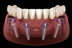 Implant-supported lower denture
