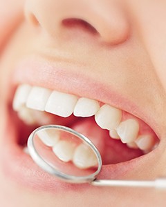 Closeup of patient with tooth-colored filling in Allentown