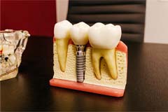 Dental model of a single tooth implant