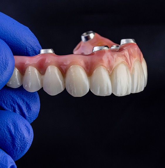  The implant denture process begins with a consultation with Dr. Young