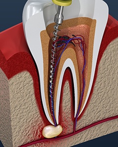 an illustration of the root canal process