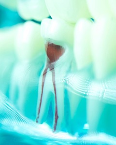 a model example of root canal therapy in Allentown