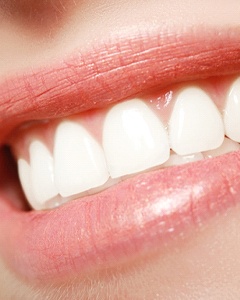 Close up of women’s veneers in Allentown