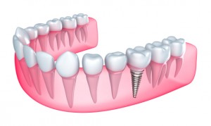 dental implants