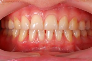 person smiling healthy gums exposed