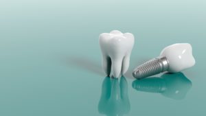 Dental implants in Allentown replacing molars.