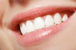 Woman’s teeth after getting veneers