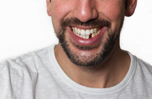 Close up of a man with a missing lower tooth