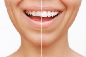 Nose-to-neck view of a smile half treated with veneers